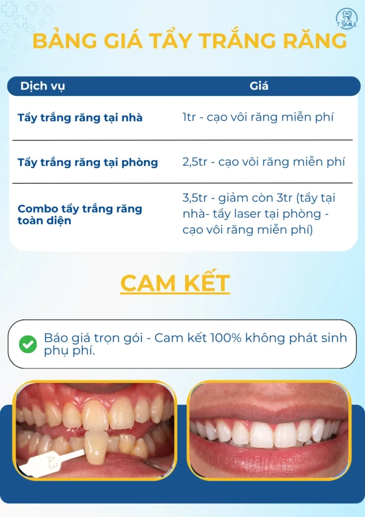 bảng giá tẩy trắng răng