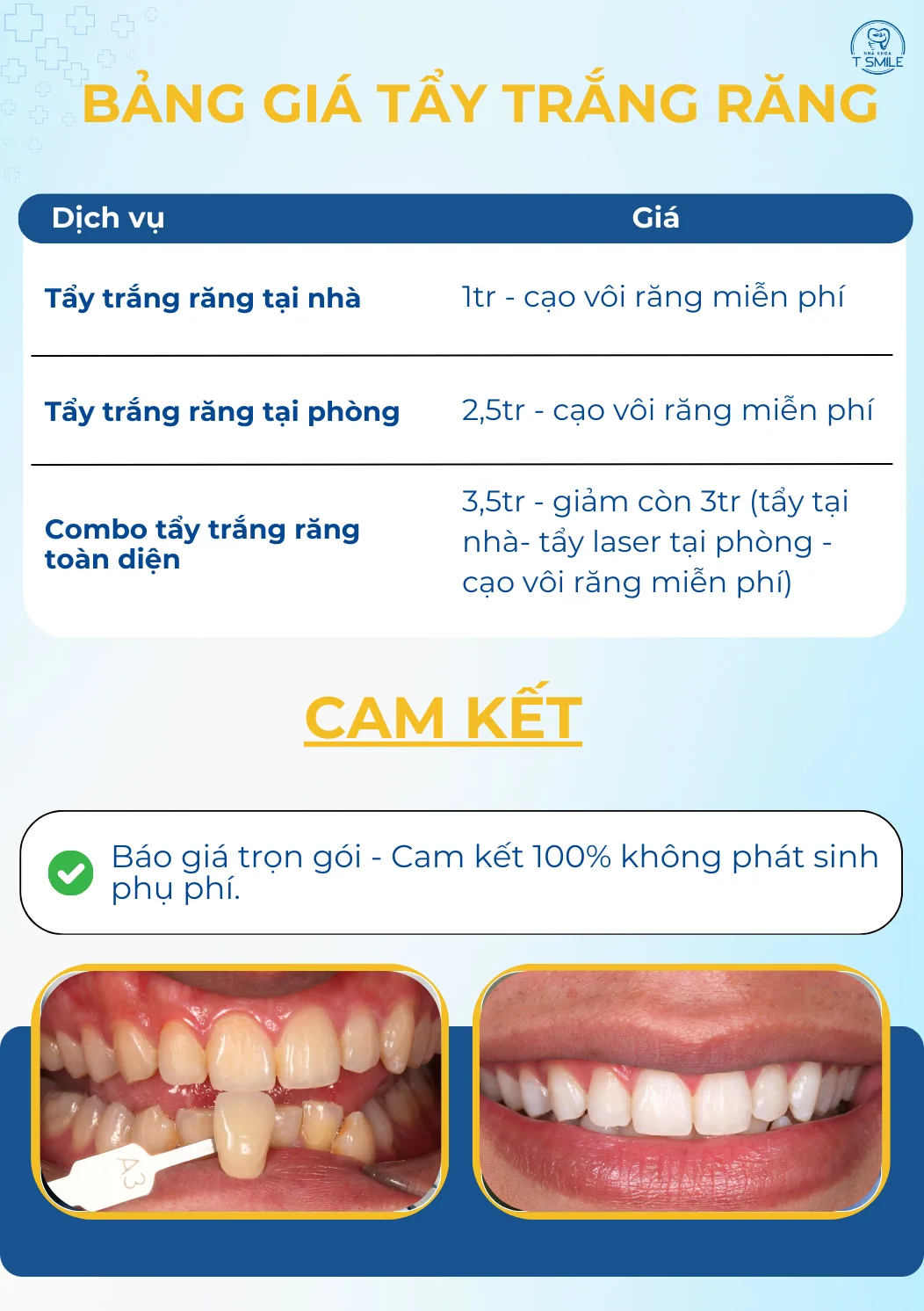 bảng giá tẩy trắng răng