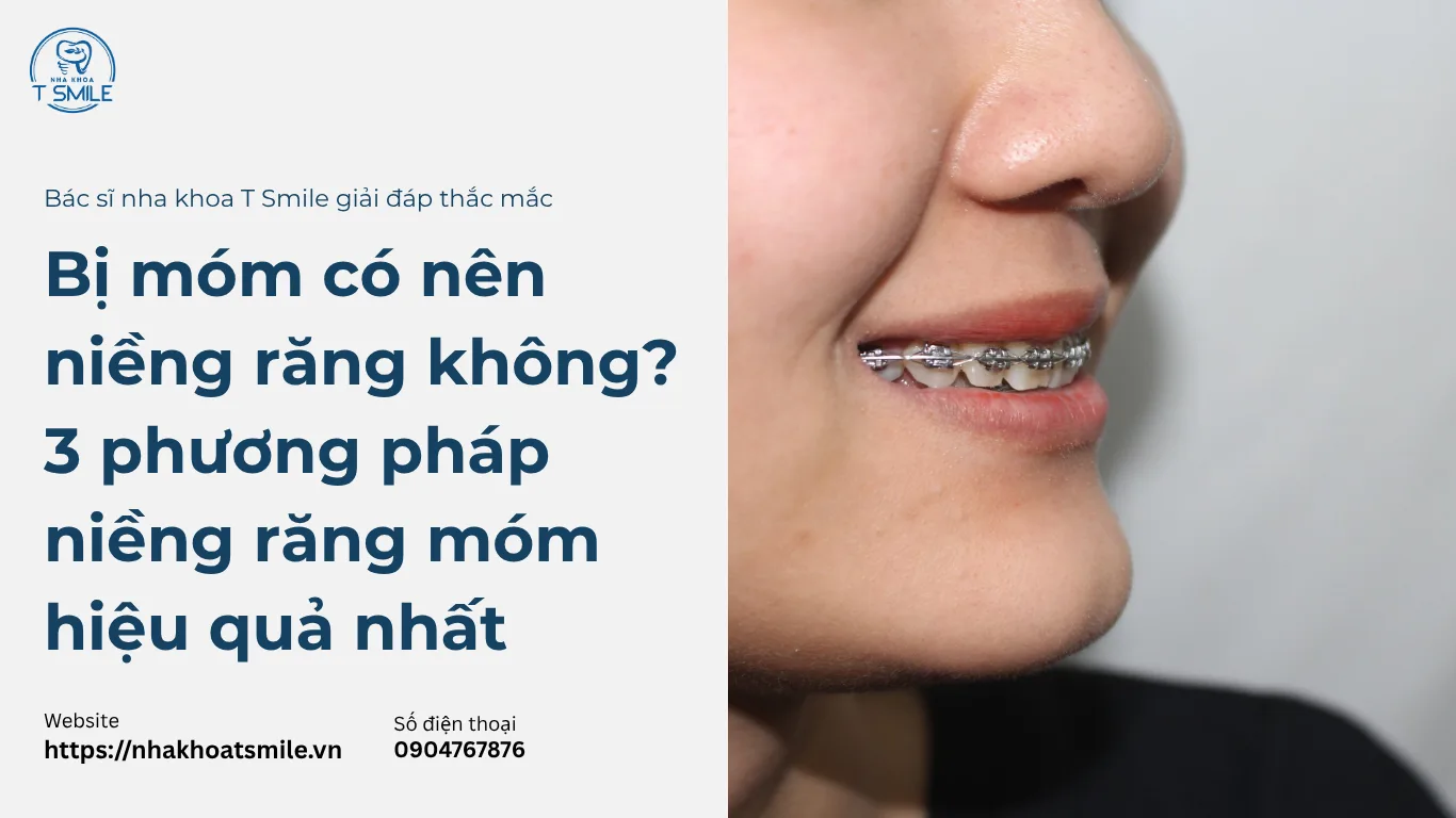 bị móm có nên niềng răng không