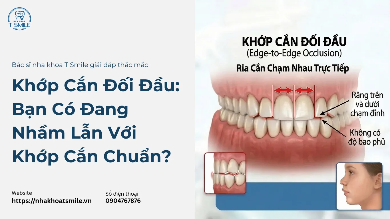 khớp cắn đối đầu là gì