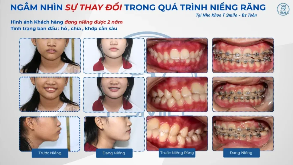 niềng răng tại Tsmile