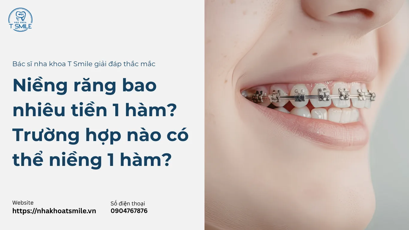 niềng răng bao nhiêu tiền 1 hàm