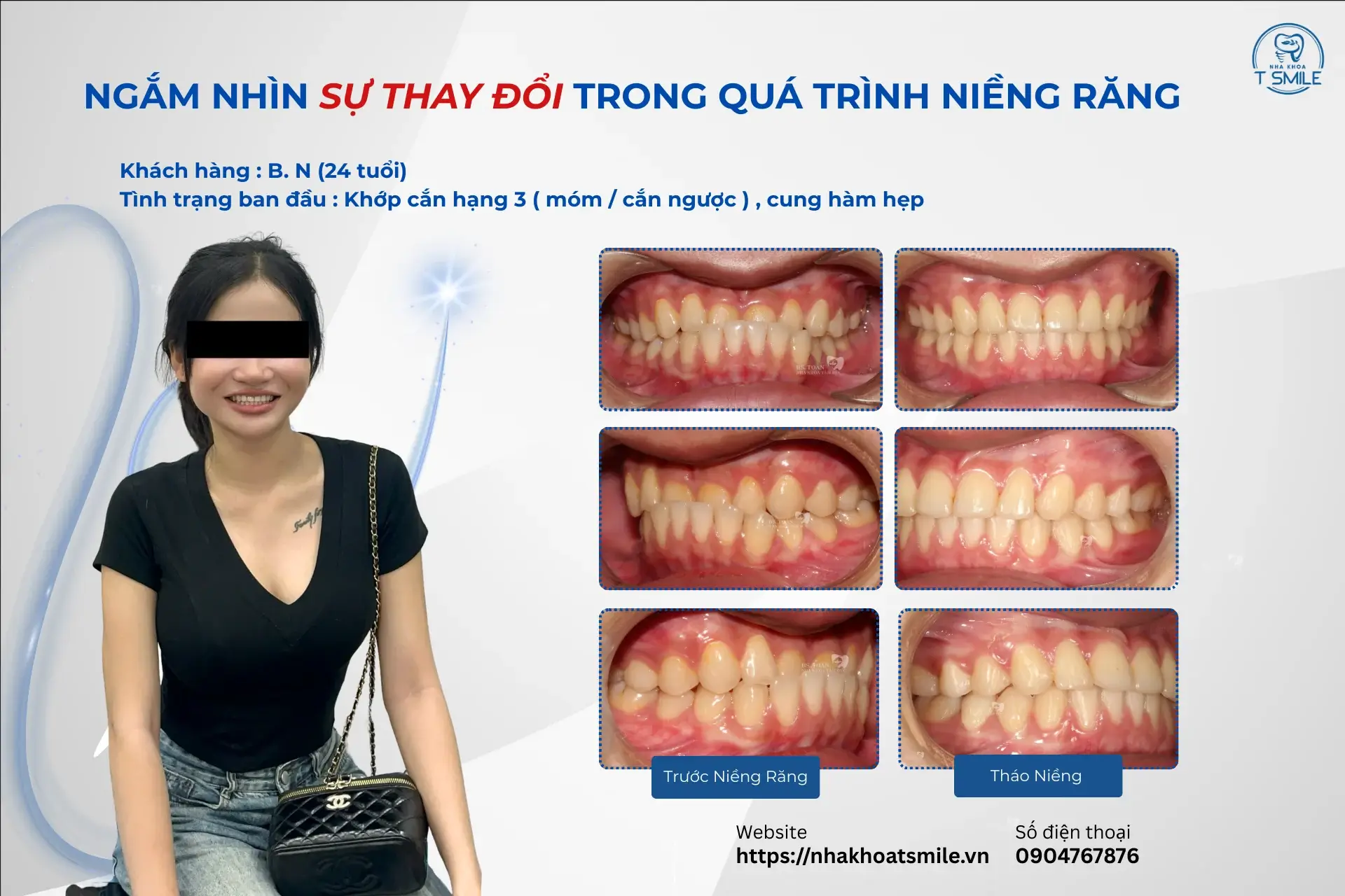 niềng răng có được vĩnh viễn không