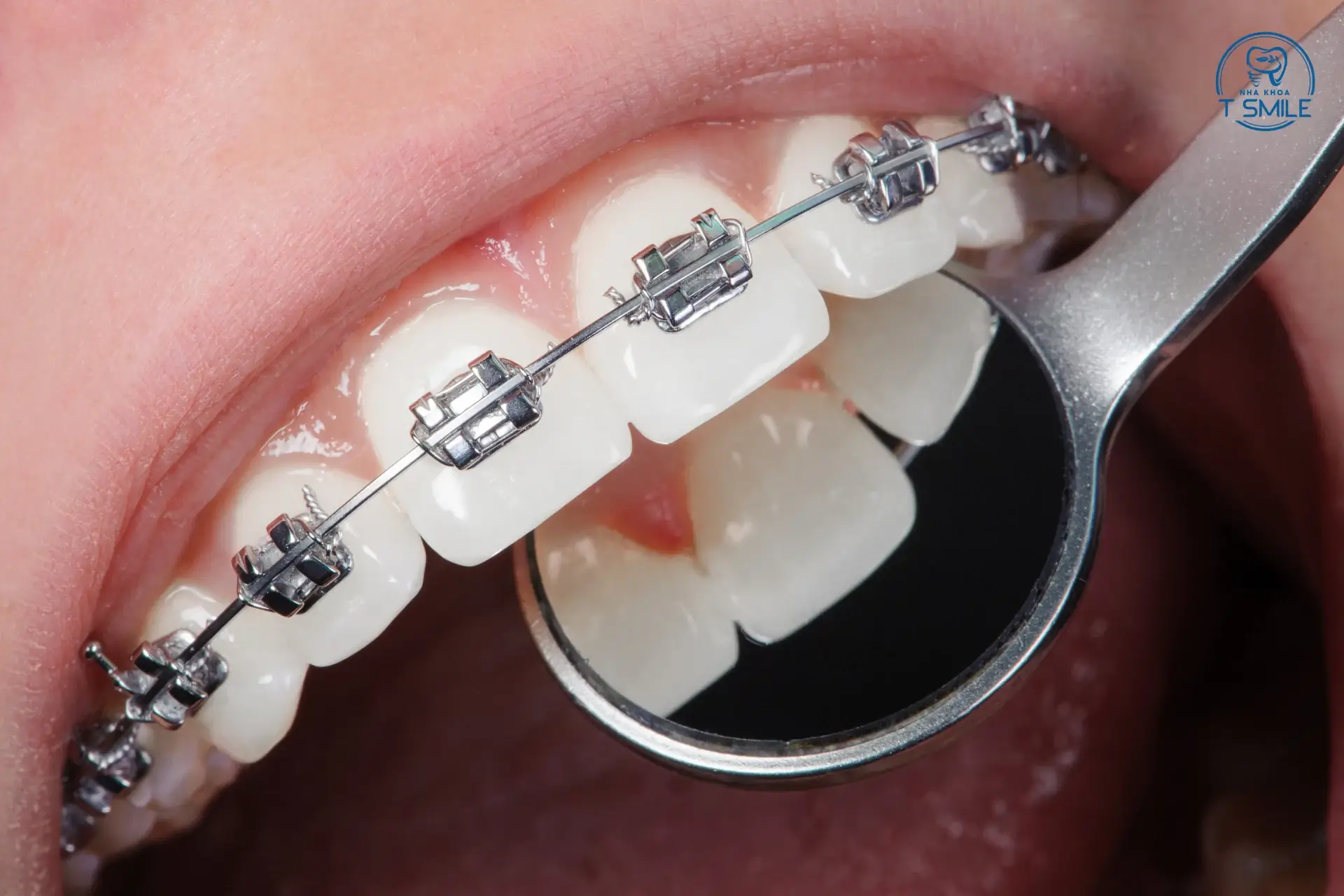 niềng răng có được vĩnh viễn không