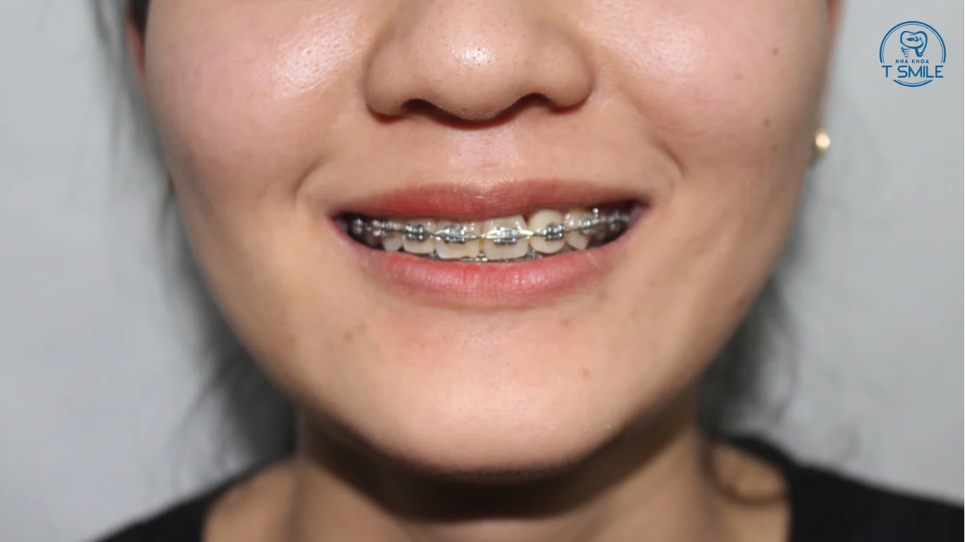 niềng răng mắc cài tự động là gì