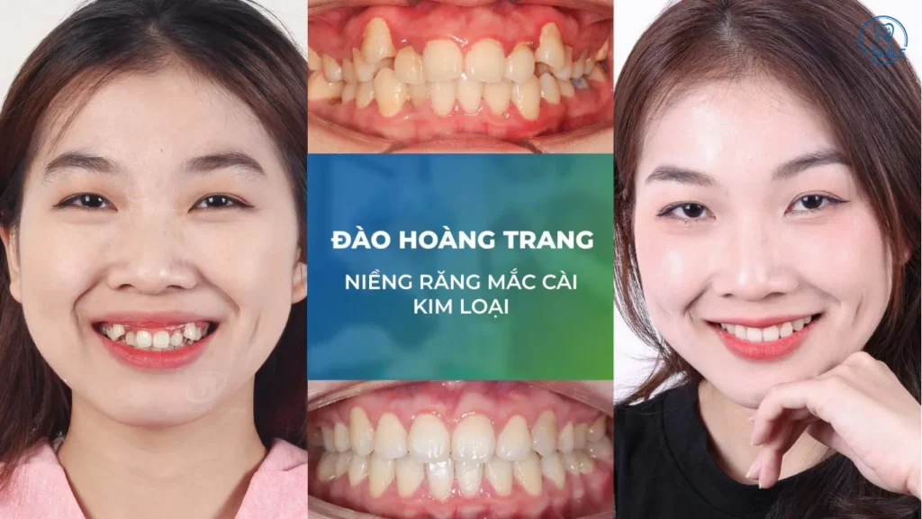 niềng răng lệch lạc