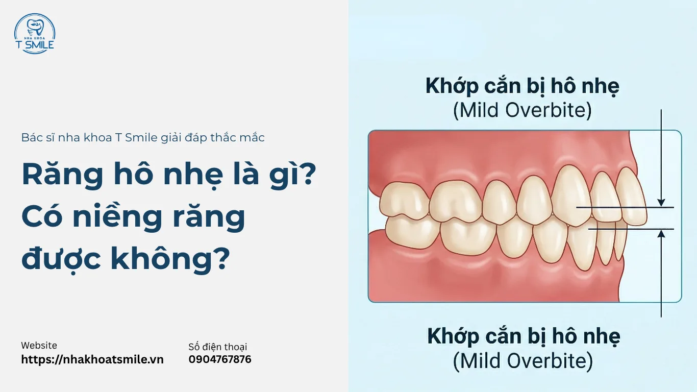 răng hô nhẹ là gì