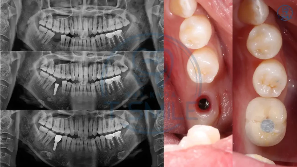 trồng răng implant