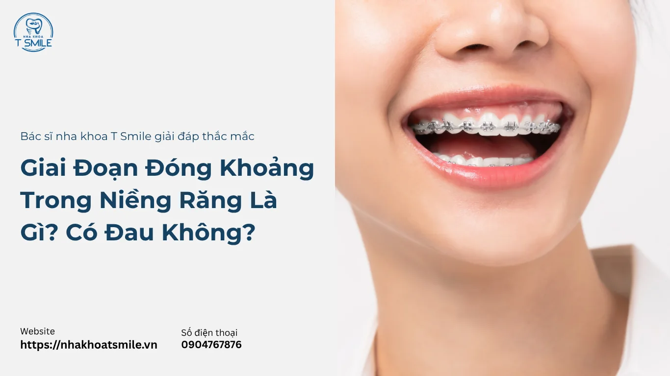 giai đoạn đóng khoảng trong niềng răng