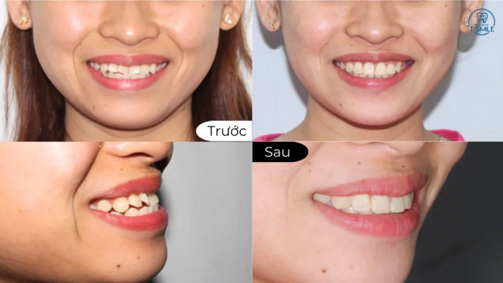 bị móm có niềng răng được không