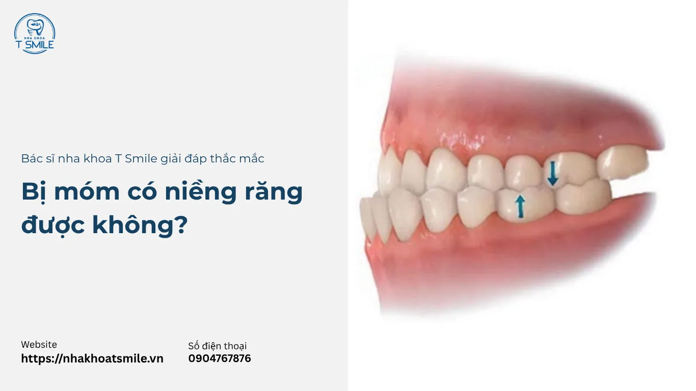 bị móm có niềng răng được không