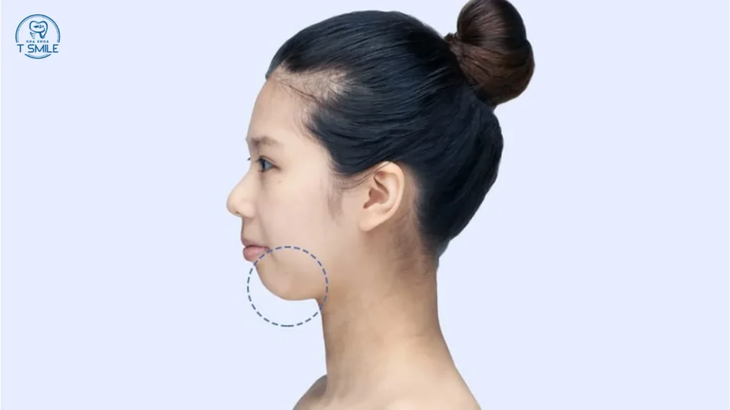 cằm lẹm niềng răng