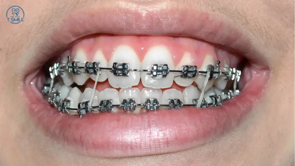 dây thun niềng răng bị vàng