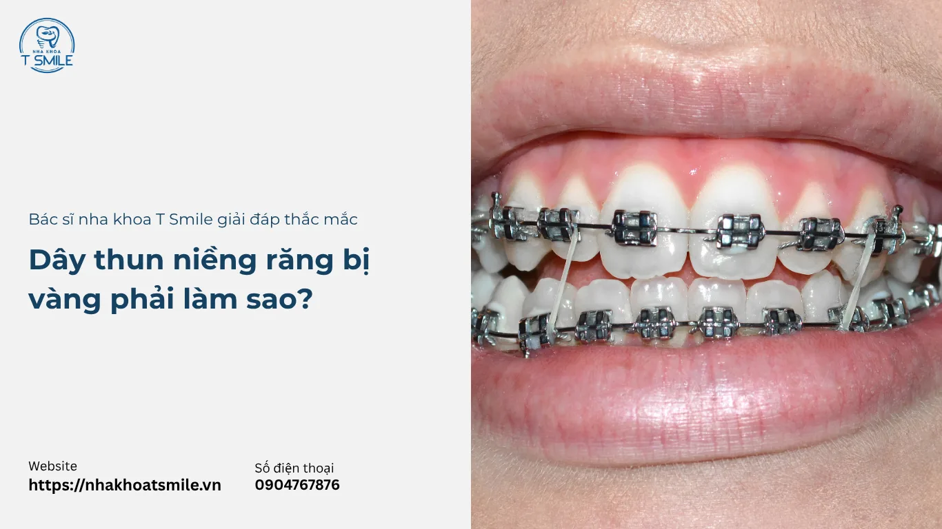 dây thun niềng răng bị vàng