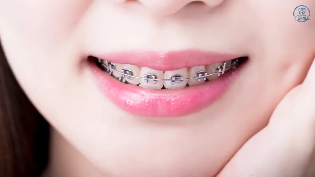 viêm nha chu có niềng răng được không
