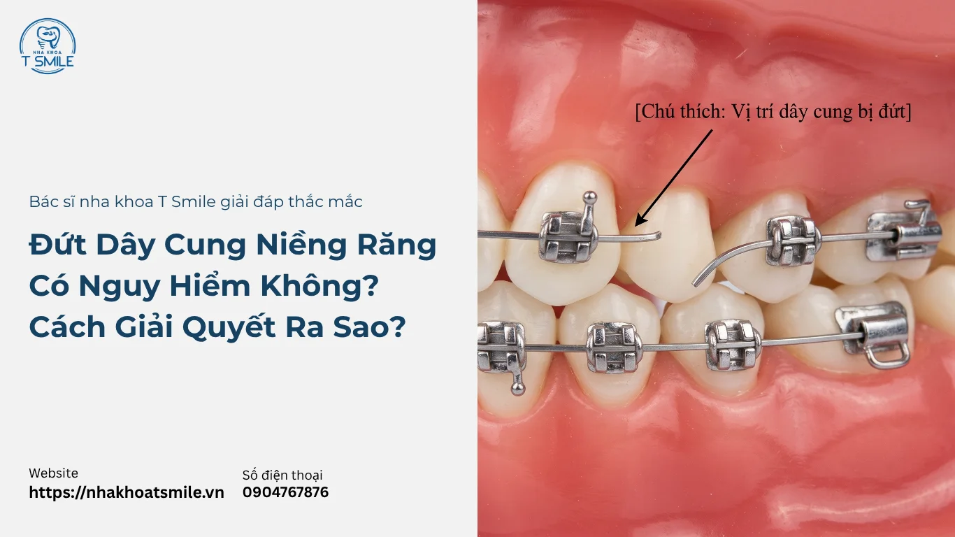 đứt dây cung niềng răng