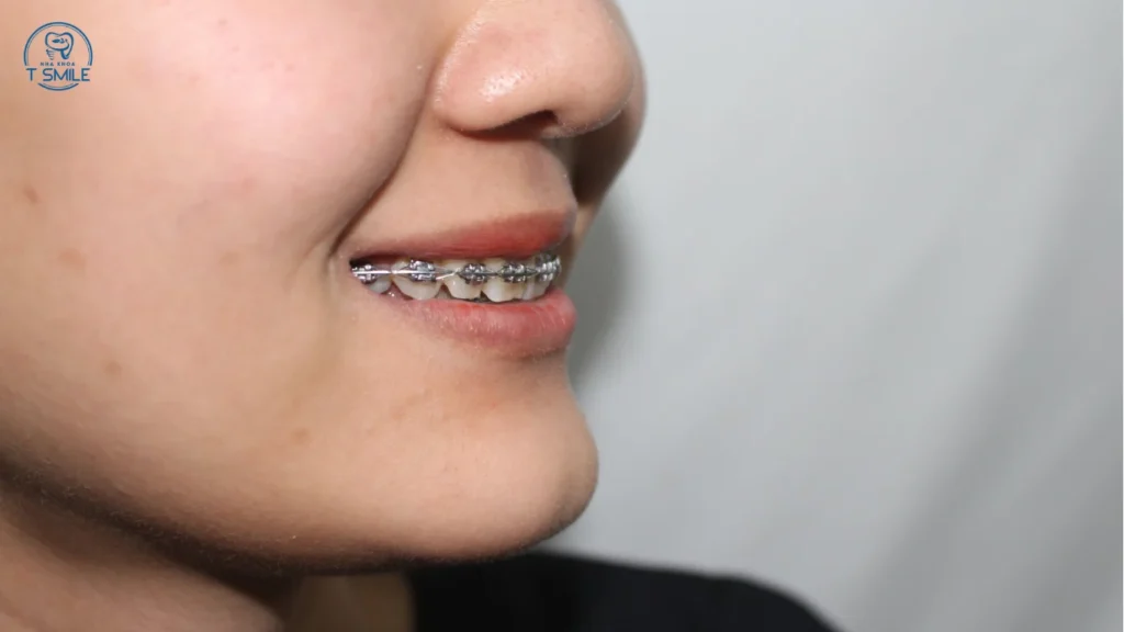 gắn khâu niềng răng