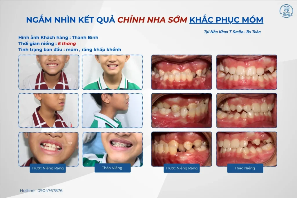 giá niềng răng cho trẻ 10 tuổi