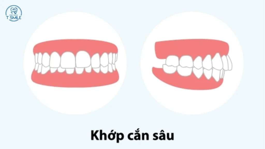 khớp cắn sâu là gì