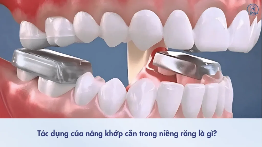 nâng khớp cắn trong niềng răng