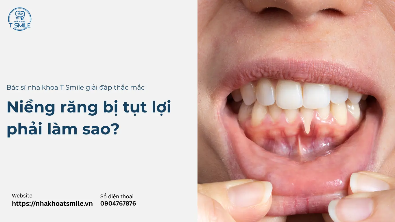 niềng răng bị tụt lợi