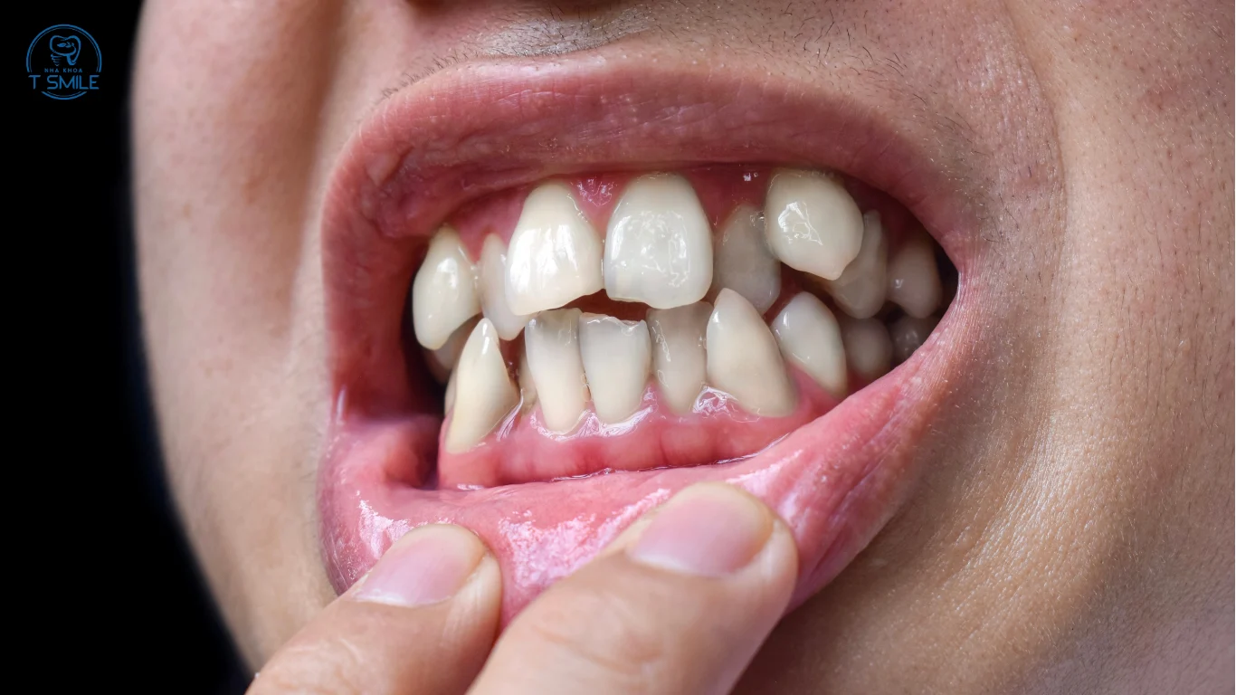 niềng răng lệch lạc