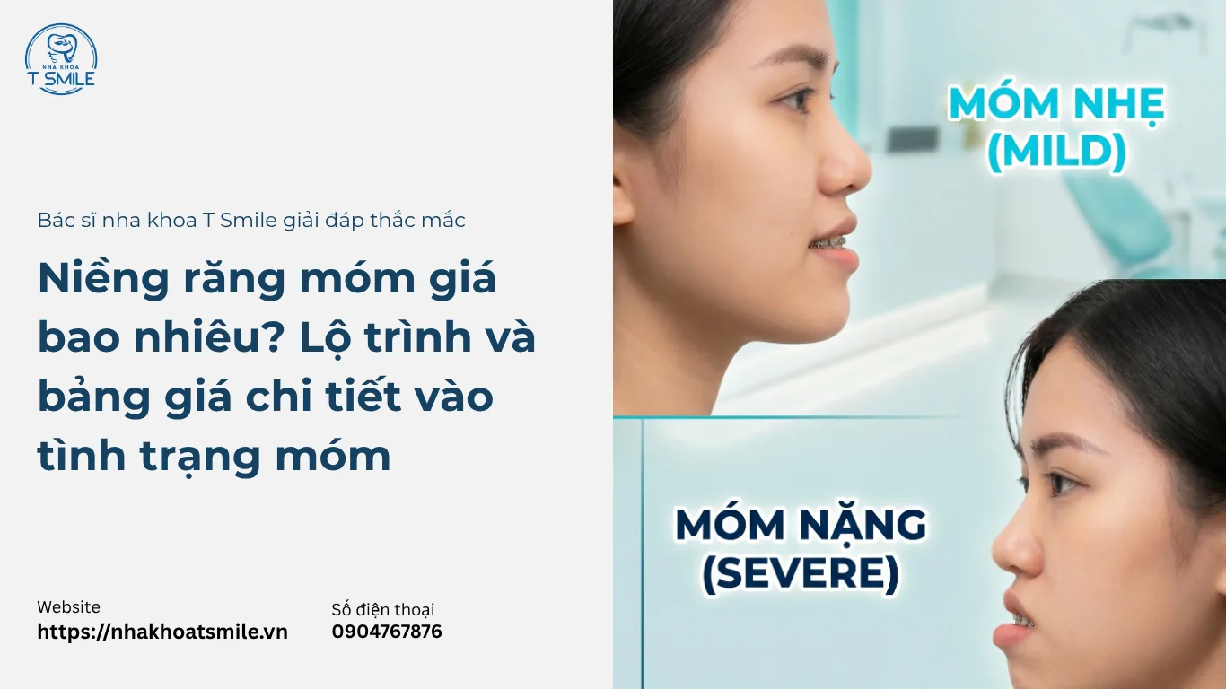 niềng răng móm giá bao nhiêu