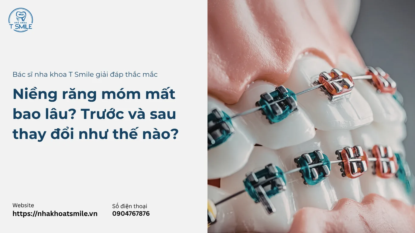 niềng răng móm mất bao lâu