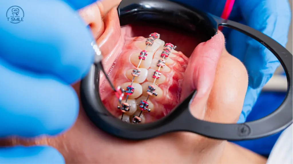 tại sao niềng răng lại đắt