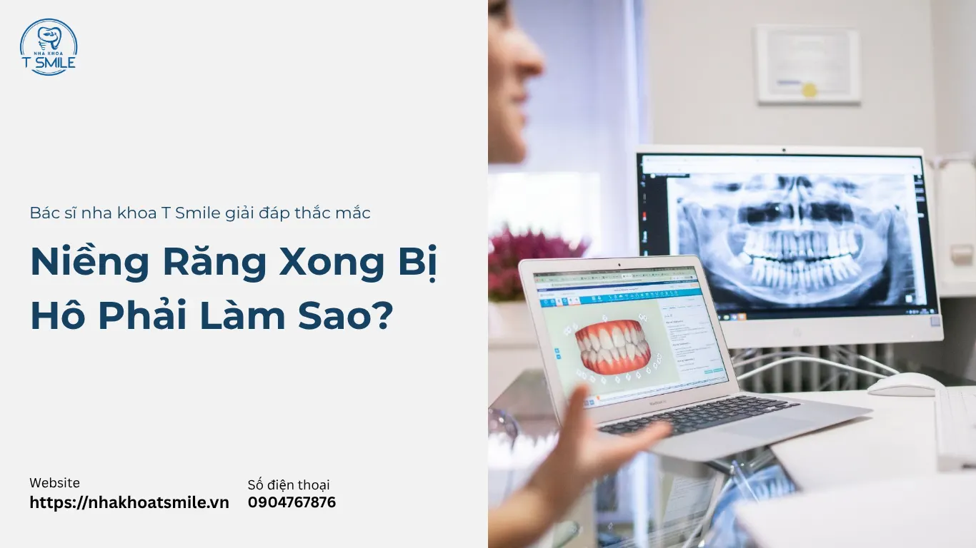 niềng răng xong bị hô