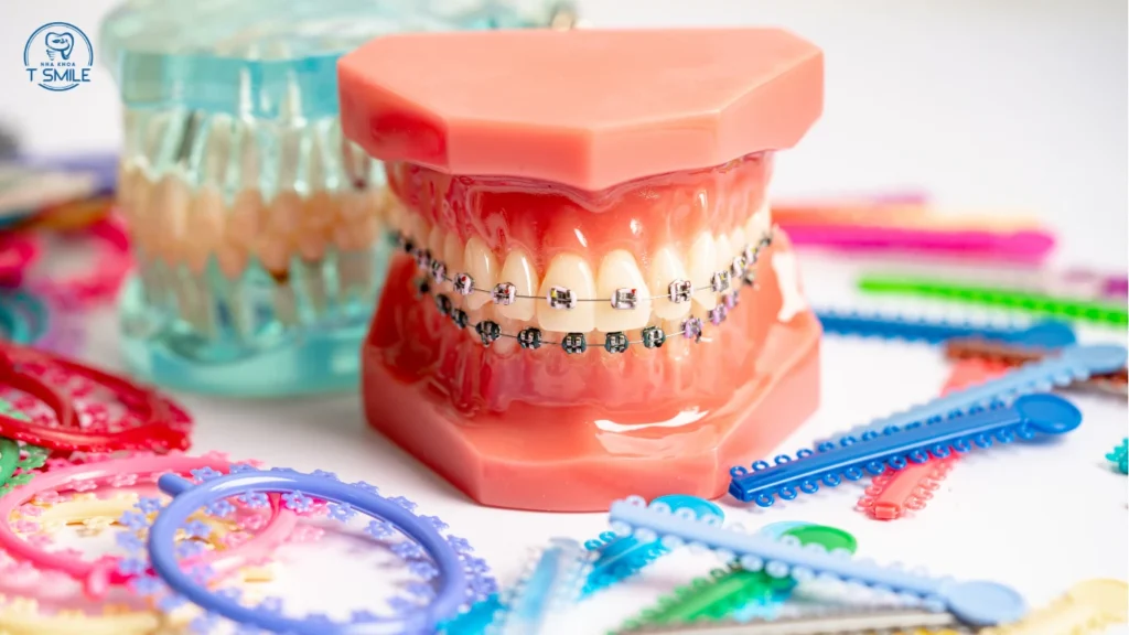 lỡ nuốt dây thun niềng răng có sao không