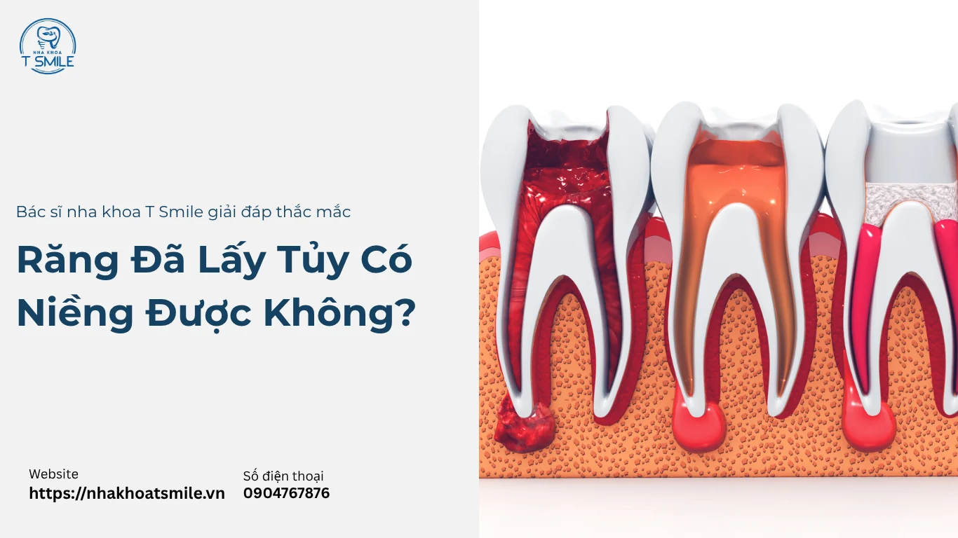 răng đã lấy tuỷ có niềng được không