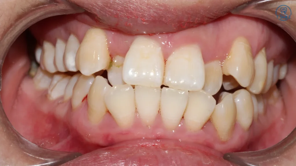 răng khấp khểnh có nên niềng không