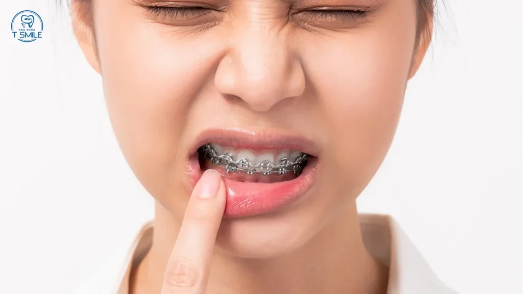 bỏ niềng răng giữa chừng