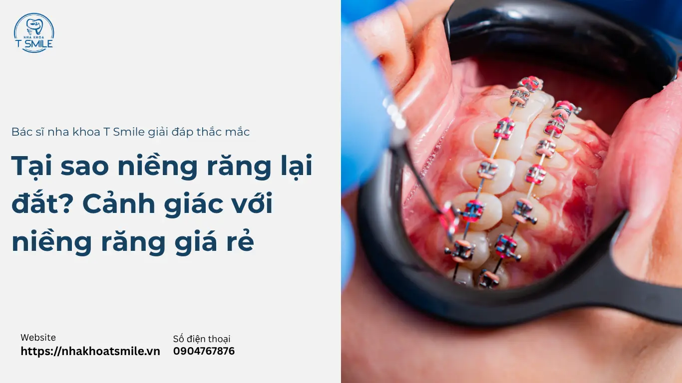 tại sao niềng răng lại đắt