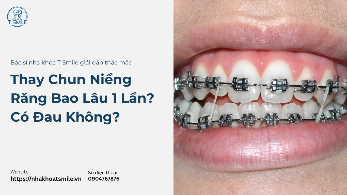 thay chun niềng răng