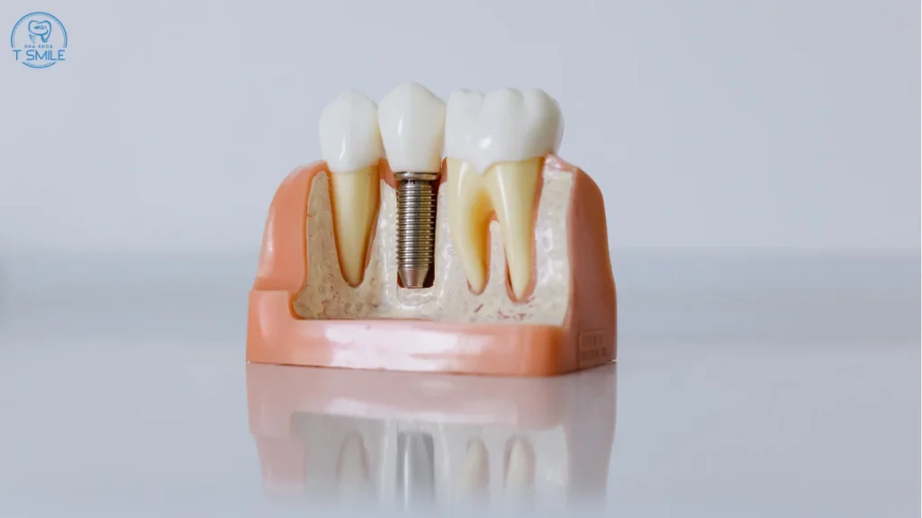 Trồng răng có niềng được không
