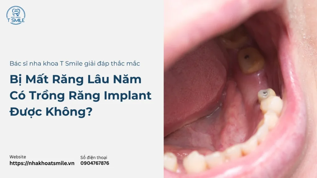 mất răng lâu năm có trồng implant được không