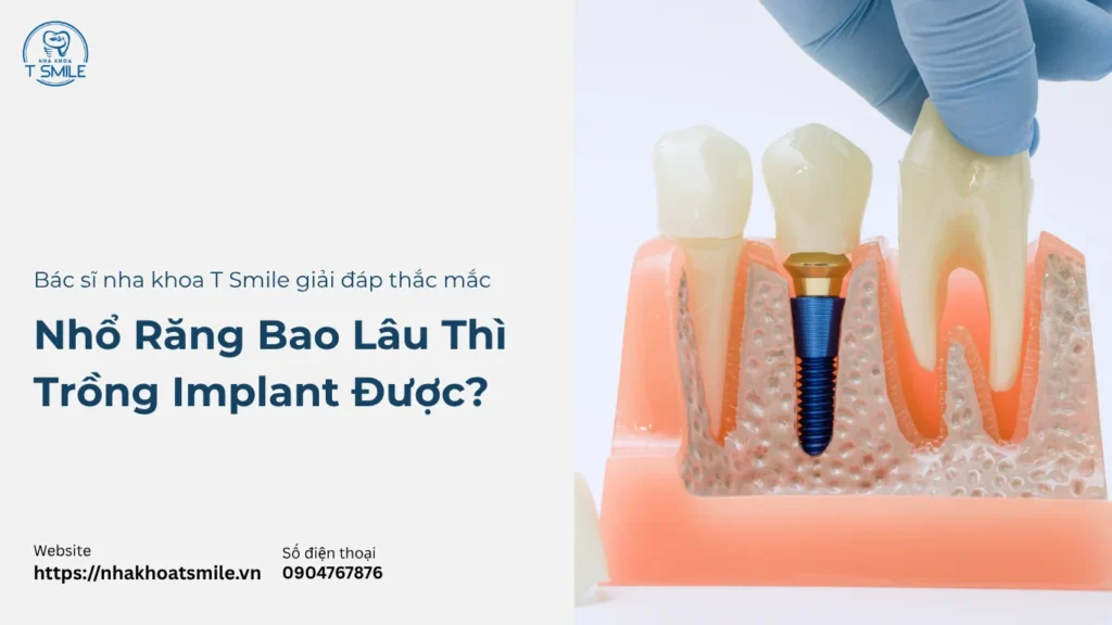 nhổ răng bao lâu thì trồng implant