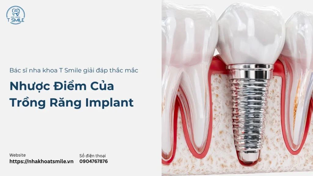 nhược điểm của trồng răng implant