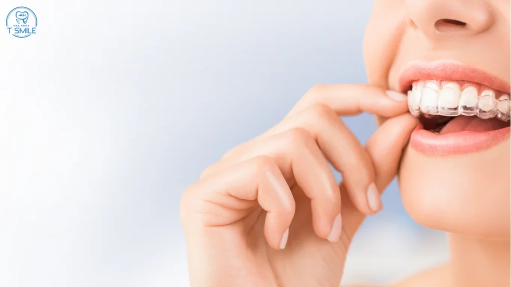 niềng răng Invisalign là gì