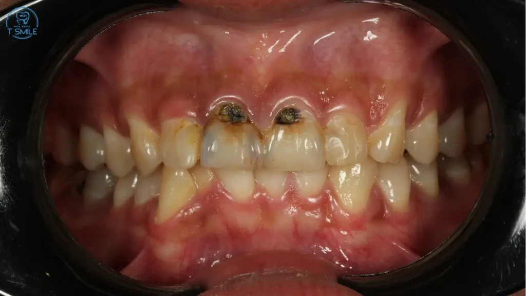 răng cửa bị sâu có trám được không