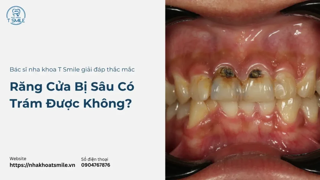 răng cửa bị sâu có trám được không