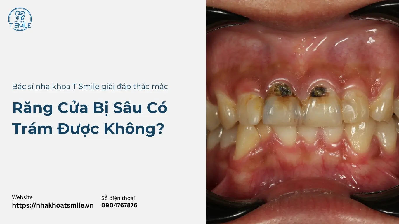 răng cửa bị sâu có trám được không