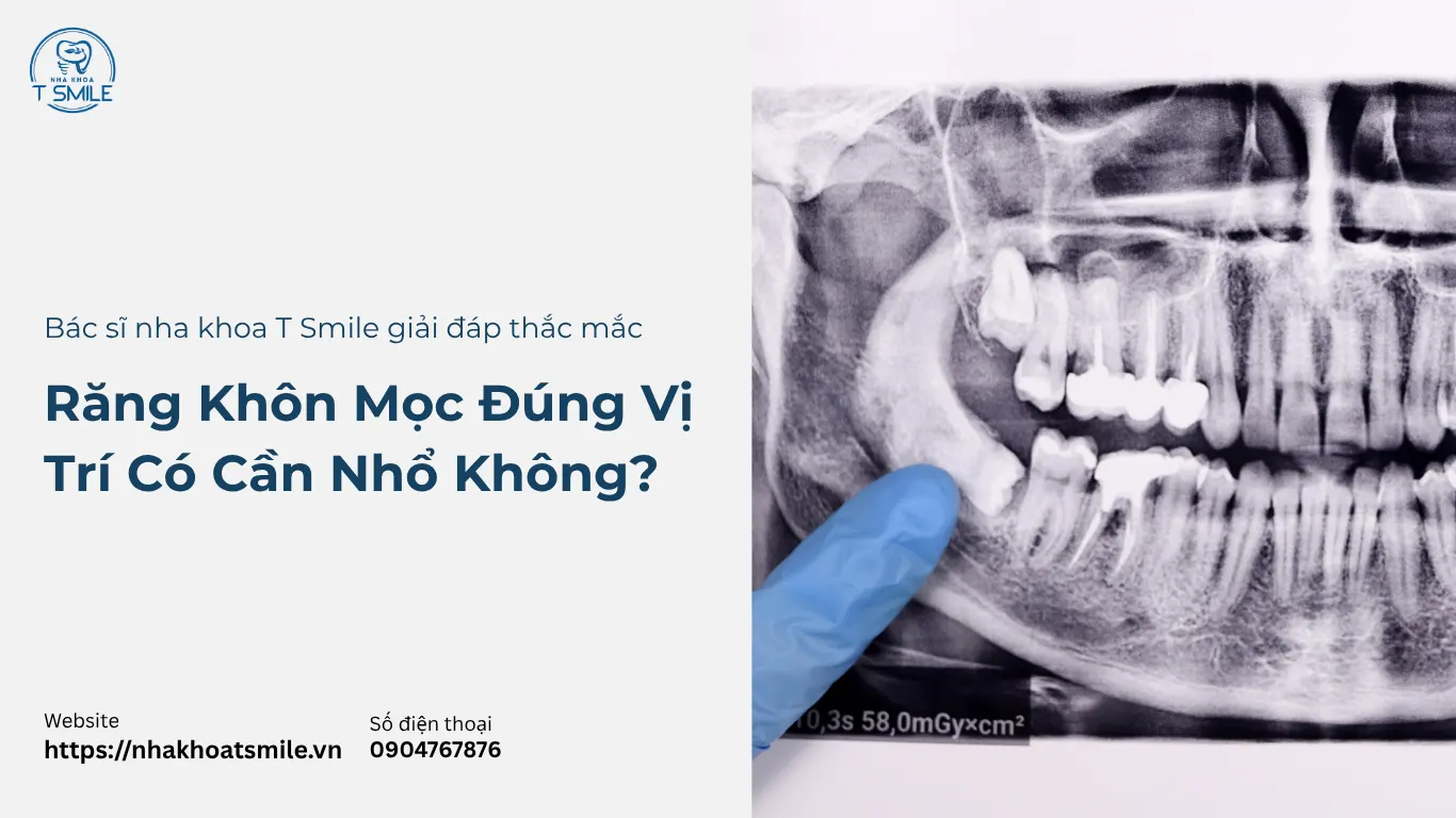 răng khôn mọc đúng vị trí
