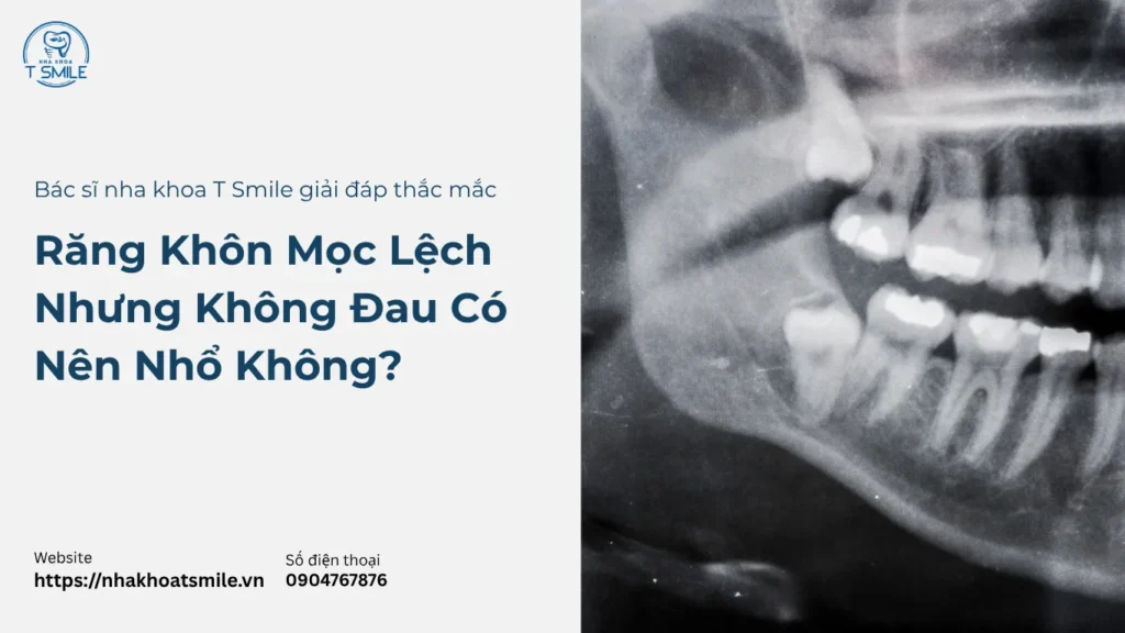 Răng Khôn Mọc Lệch Nhưng Không Đau Có Nên Nhổ Không?