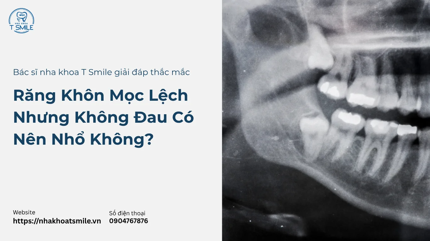 Răng Khôn Mọc Lệch Nhưng Không Đau Có Nên Nhổ Không?