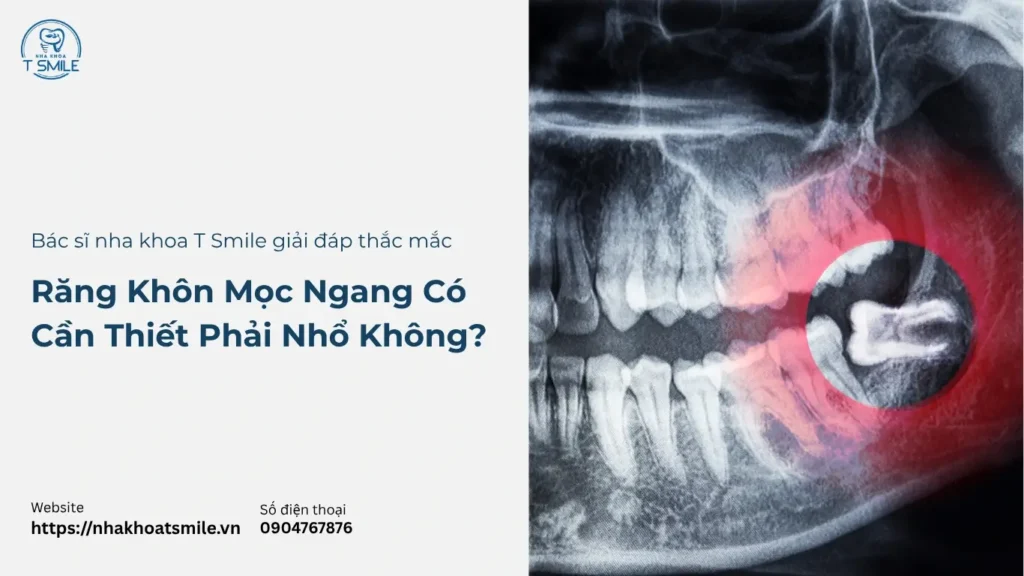 răng khôn mọc ngang