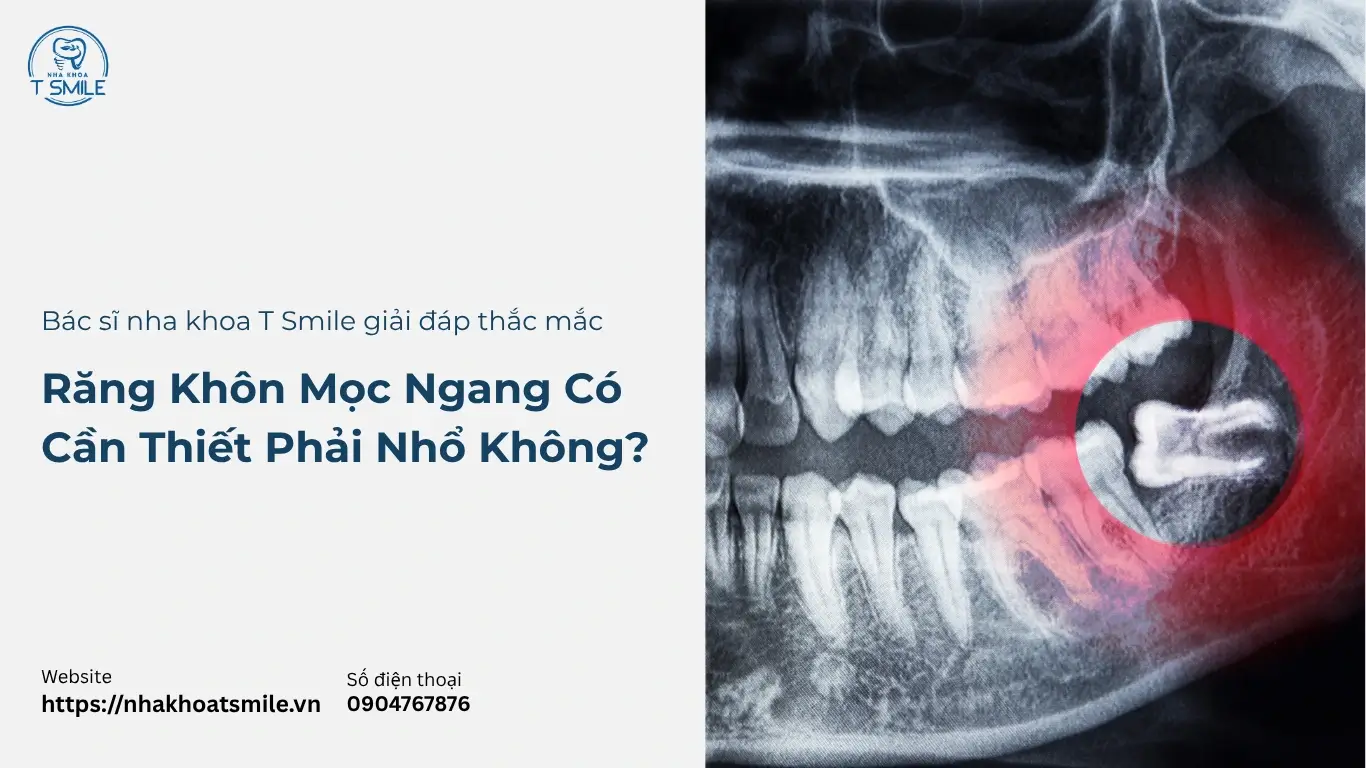 răng khôn mọc ngang