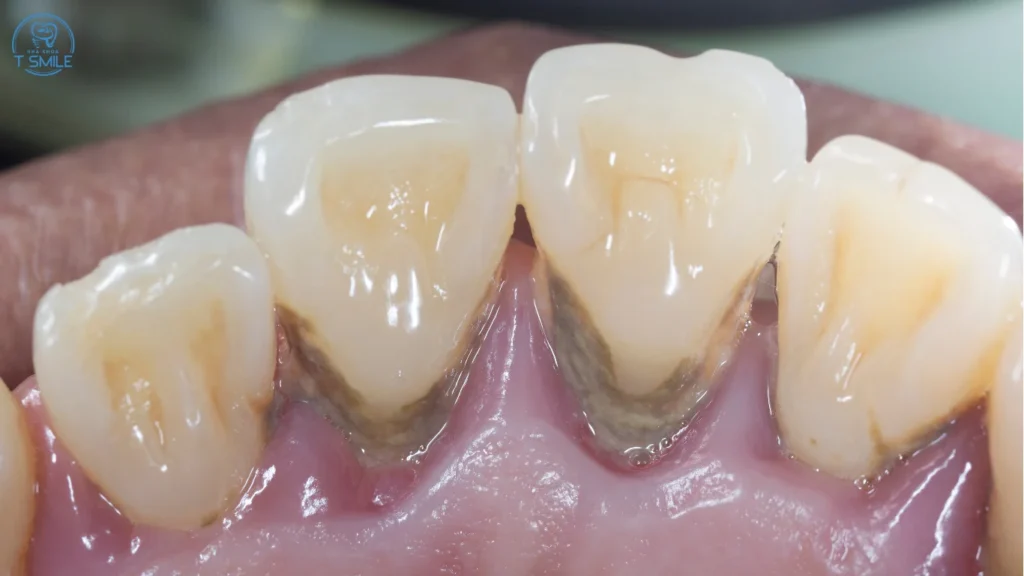 răng lung lay có giữ được không​
